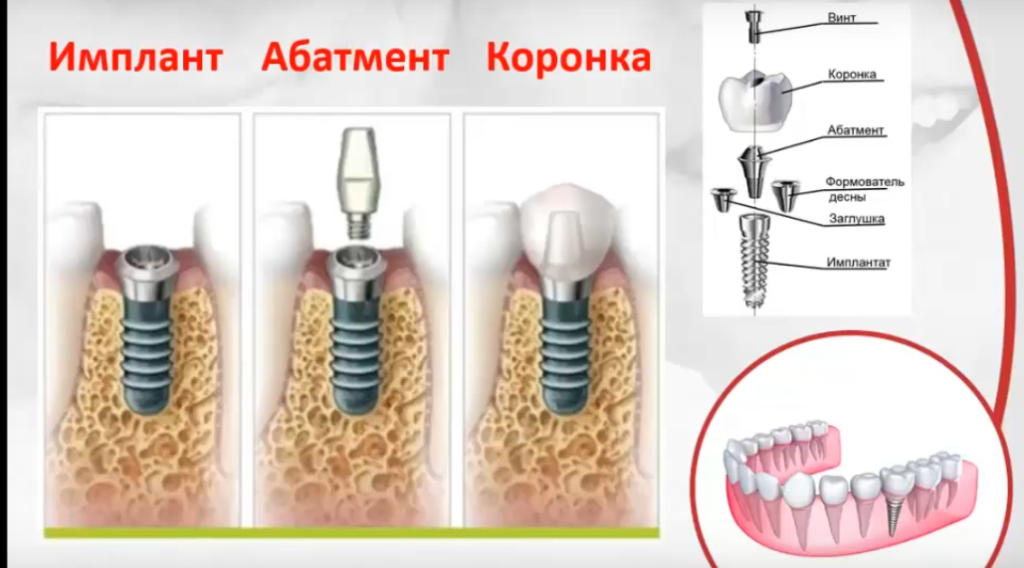 Имплант авто кемерово